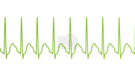 Téléchargez les photos : ECG dans la tachycardie supraventriculaire, une fréquence cardiaque rapide provenant au-dessus des ventricules, provoquant des palpitations et des étourdissements. L'illustration 3D montre des complexes QRS étroits et des ondes P cachées dans les ondes T. - en image libre de droit