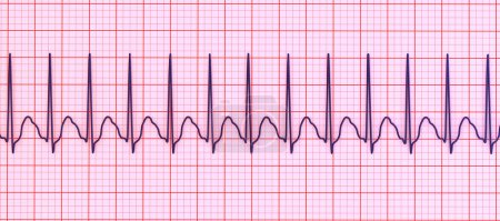 Photo for ECG in supraventricular tachycardia, a rapid heart rate originating above the ventricles, causing palpitations and dizziness. 3D illustration shows narrow QRS complexes and P waves hidden in T waves. - Royalty Free Image