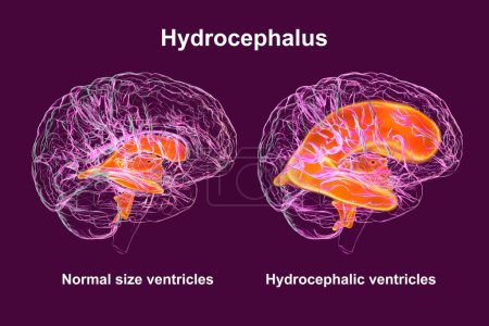 Foto de Ilustración científica en 3D que representa ventrículos agrandados del cerebro del niño (hidrocefalia, lado derecho) y del sistema ventricular normal (lado izquierdo)). - Imagen libre de derechos