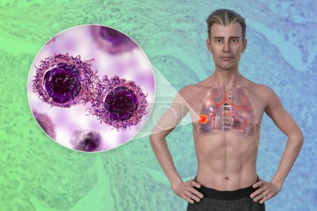 Téléchargez les photos : Illustration photoréaliste 3D de la moitié supérieure d'un homme à la peau transparente, révélant la présence d'un cancer du poumon, et vue rapprochée des cellules cancéreuses. - en image libre de droit