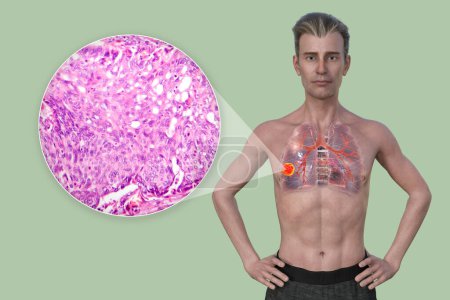 Téléchargez les photos : Un homme atteint d'un cancer du poumon, illustration 3D, avec une image micrographique de l'adénocarcinome pulmonaire. - en image libre de droit
