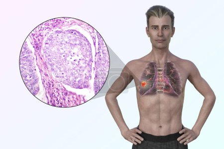 Foto de Un hombre con cáncer de pulmón, ilustración 3D, junto con una imagen micrográfica de adenocarcinoma de pulmón. - Imagen libre de derechos