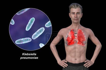 Téléchargez les photos : Illustration photoréaliste 3D montrant la moitié supérieure d'un homme à la peau transparente, révélant les poumons atteints de pneumonie, et vue rapprochée de la bactérie Klebsiella pneumoniae. - en image libre de droit