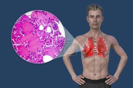 Téléchargez les photos : Illustration photoréaliste 3D montrant la moitié supérieure d'un homme à la peau transparente, révélant les poumons atteints de pneumonie, ainsi qu'une image micrographique de la pneumonie. - en image libre de droit