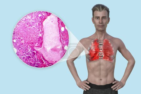 Téléchargez les photos : Illustration photoréaliste 3D montrant la moitié supérieure d'un homme à la peau transparente, révélant les poumons atteints de pneumonie, ainsi qu'une image micrographique de la pneumonie. - en image libre de droit