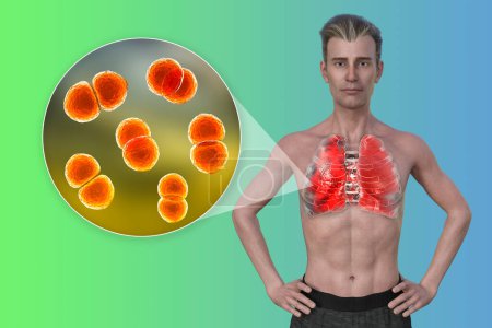 Téléchargez les photos : Illustration photoréaliste 3D montrant la moitié supérieure d'un homme à peau transparente, révélant les poumons atteints de pneumonie, et vue rapprochée de la bactérie Streptococcus pneumoniae. - en image libre de droit