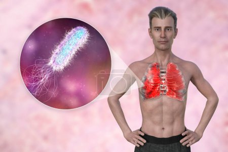Téléchargez les photos : Illustration photoréaliste 3D montrant la moitié supérieure d'un homme à peau transparente, révélant les poumons atteints de pneumonie, et vue rapprochée de la bactérie Pseudomonas aeruginosa. - en image libre de droit