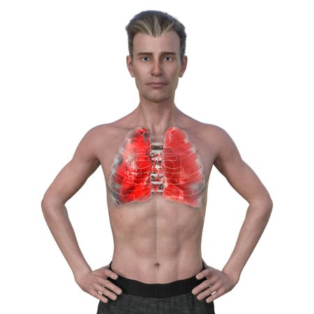 Téléchargez les photos : Illustration photoréaliste 3D montrant la moitié supérieure d'un homme à la peau transparente, révélant les poumons atteints de pneumonie. - en image libre de droit