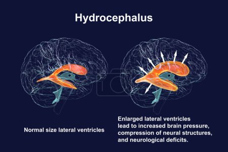 Foto de Ilustración científica en 3D que muestra el agrandamiento de los ventrículos laterales del cerebro del niño (hidrocefalia, lado derecho) y el sistema ventricular normal (lado izquierdo)). - Imagen libre de derechos