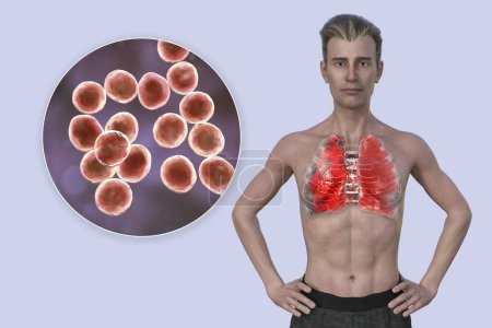 Téléchargez les photos : Illustration photoréaliste 3D montrant la moitié supérieure d'un homme à la peau transparente, révélant les poumons atteints de pneumonie, et vue rapprochée de la bactérie Staphylococcus aureus. - en image libre de droit