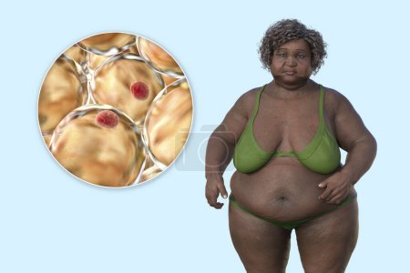 Foto de Una ilustración médica en 3D que representa a una mujer con sobrepeso con una visión cercana de los adipocitos, destacando el papel de estas células grasas en la obesidad. - Imagen libre de derechos