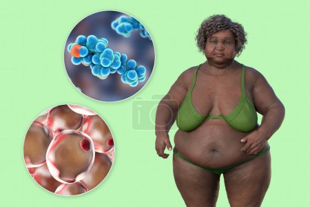 Téléchargez les photos : Illustration médicale 3D montrant une femme en surpoids avec une vue rapprochée des adipocytes et des molécules de cholestérol, mettant en évidence la relation entre l'obésité et le métabolisme du cholestérol. - en image libre de droit