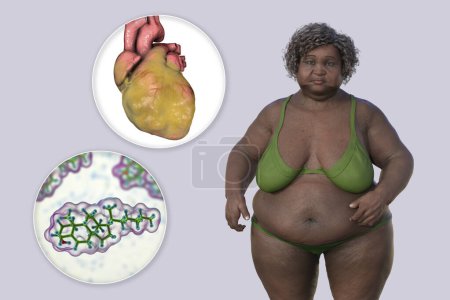 Téléchargez les photos : Molecule de cholestérol et coeur obèse chez la femme en surpoids, illustration 3D. Concept d'obésité et maladies des organes internes dues à la dyslipidémie. - en image libre de droit
