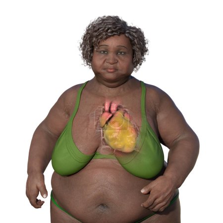 Foto de Una ilustración médica en 3D de una mujer mayor con sobrepeso y piel transparente, mostrando un corazón agrandado y obeso. - Imagen libre de derechos