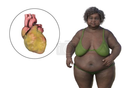 Téléchargez les photos : Illustration scientifique 3D représentant une femme obèse à la peau transparente, révélant un anévrisme aortique ascendant, un concept soulignant l'association de l'anévrisme aortique ascendant avec l'obésité. - en image libre de droit