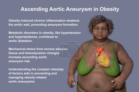 Téléchargez les photos : Illustration scientifique 3D représentant une femme obèse à la peau transparente, révélant un anévrisme aortique ascendant, un concept soulignant l'association de l'anévrisme aortique ascendant avec l'obésité. - en image libre de droit