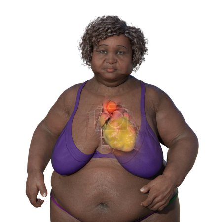 Foto de Ilustración científica en 3D que representa a una mujer obesa con piel transparente, revelando un aneurisma aórtico ascendente, un concepto que destaca la asociación del aneurisma aórtico ascendente con la obesidad. - Imagen libre de derechos