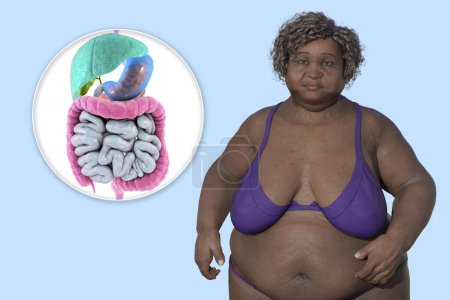 Photo for An overweight woman and close-up view of digestive system, 3D illustration highlighting the digestive problems associated with obesity. - Royalty Free Image