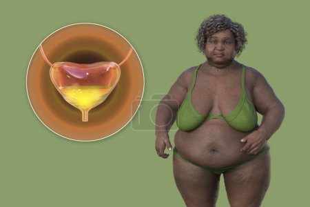Téléchargez les photos : Illustration 3D scientifique d'une femme âgée en surpoids avec une vue rapprochée de sa vessie, conceptualisant les problèmes urinaires liés à l'obésité, y compris la vessie hyperactive. - en image libre de droit