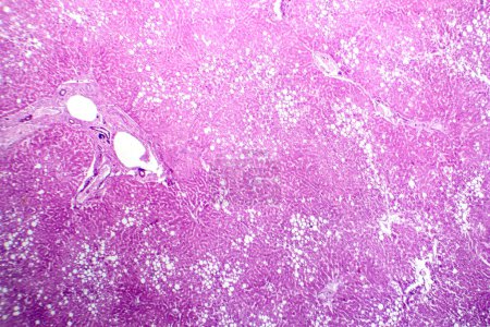 Foto de Fotomicrografía de esteatosis hepática, revelando acumulación de grasa en las células hepáticas, conocida como enfermedad hepática grasa. - Imagen libre de derechos