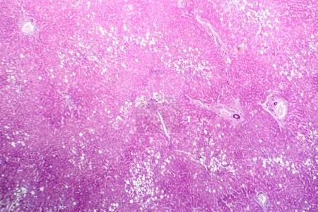 Téléchargez les photos : Photomicrographie de la stéatose hépatique, révélant une accumulation de graisse dans les cellules hépatiques, connue sous le nom de stéatose hépatique grasse. - en image libre de droit