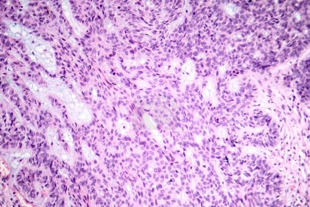 Fotomicrografía del carcinoma basocelular, mostrando células basales malignas típicas del cáncer de piel más común.
