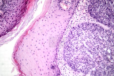 Téléchargez les photos : Photomicrographie du carcinome basocellulaire, montrant des cellules basales malignes typiques du cancer de la peau le plus fréquent. - en image libre de droit
