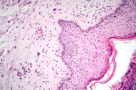 Téléchargez les photos : Photomicrographie du carcinome basocellulaire, montrant des cellules basales malignes typiques du cancer de la peau le plus fréquent. - en image libre de droit