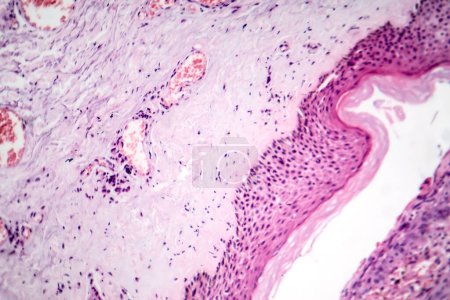 Foto de Fotomicrografía del carcinoma basocelular, mostrando células basales malignas típicas del cáncer de piel más común. - Imagen libre de derechos