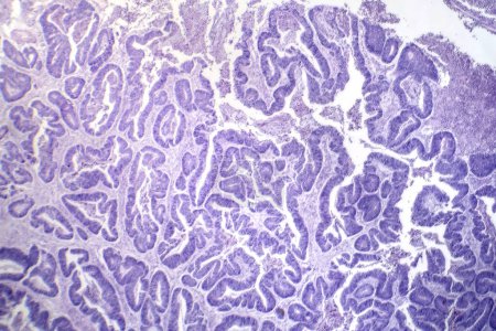 Foto de Fotomicrografía del carcinoma de células escamosas esofágicas, que muestra células escamosas malignas características del cáncer de esófago. - Imagen libre de derechos