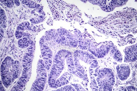 Photo for Photomicrograph of esophageal squamous cell carcinoma, showing malignant squamous cells characteristic of esophageal cancer. - Royalty Free Image