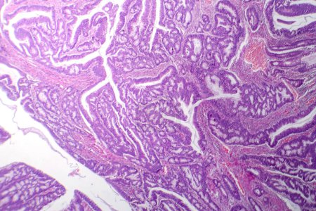 Téléchargez les photos : Photomicrographie de l'adénocarcinome du côlon, illustrant les cellules glandulaires malignes caractéristiques du cancer du côlon. - en image libre de droit