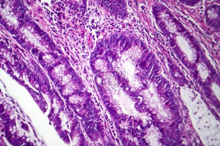 Téléchargez les photos : Photomicrographie de l'adénocarcinome du côlon, illustrant les cellules glandulaires malignes caractéristiques du cancer du côlon. - en image libre de droit