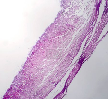 Téléchargez les photos : Photomicrographie du mélanome, mettant en évidence les mélanocytes malins, les cellules primaires responsables du cancer agressif de la peau. - en image libre de droit