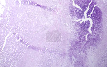 Téléchargez les photos : Photomicrographie de l'athérosclérose aortique, révélant l'accumulation de plaque et le rétrécissement de l'aorte dû aux dépôts de cholestérol. - en image libre de droit