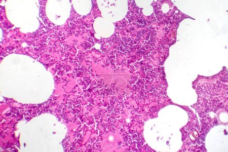 Foto de Fotomicrografía de neumonía lobar durante el período de edema hemorrágico, mostrando inflamación del tejido pulmonar con cambios hemorrágicos. - Imagen libre de derechos
