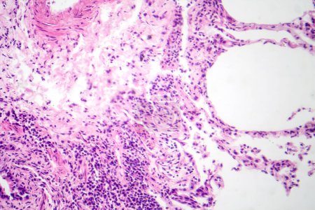 Photomicrograph of interstitial pneumonia, showing inflammation and fibrosis in the lung's interstitial tissue.