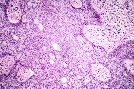 Foto de Fotomicrografía del carcinoma basocelular, mostrando células basales malignas típicas del cáncer de piel más común. - Imagen libre de derechos
