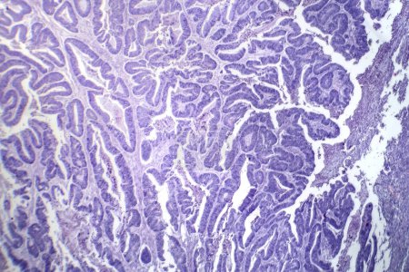 Photo for Photomicrograph of esophageal squamous cell carcinoma, showing malignant squamous cells characteristic of esophageal cancer. - Royalty Free Image
