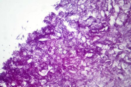 Téléchargez les photos : Photomicrographie du mélanome, mettant en évidence les mélanocytes malins, les cellules primaires responsables du cancer agressif de la peau. - en image libre de droit