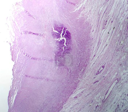 Photo for Photomicrograph of aortic atherosclerosis, revealing plaque buildup and narrowing of the aorta due to cholesterol deposits. - Royalty Free Image