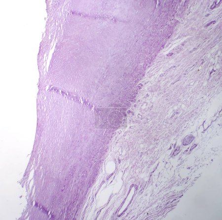 Téléchargez les photos : Photomicrographie de l'athérosclérose aortique, révélant l'accumulation de plaque et le rétrécissement de l'aorte dû aux dépôts de cholestérol. - en image libre de droit