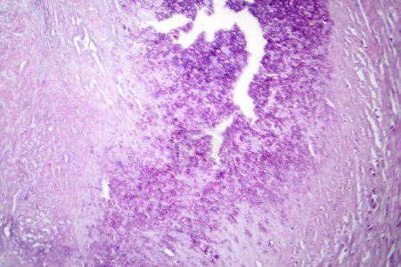 Foto de Fotomicrografía de la aterosclerosis aórtica, revelando acumulación de placa y estrechamiento de la aorta debido a depósitos de colesterol. - Imagen libre de derechos