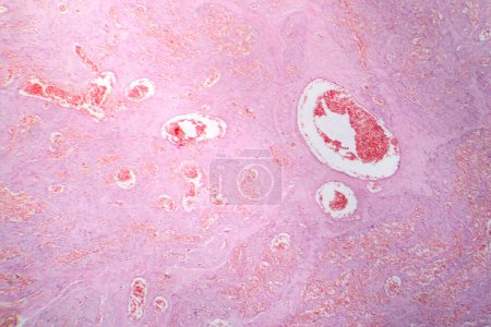 Téléchargez les photos : Photomicrographie de l'hémangiome capillaire, illustrant la prolifération anormale des capillaires, caractéristique d'une tumeur vasculaire bénigne. - en image libre de droit