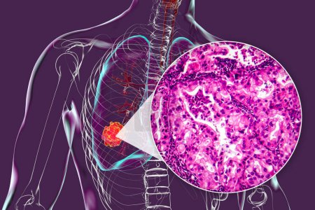 Téléchargez les photos : Un corps humain avec une peau transparente présentant un cancer du poumon, illustration 3D complétée par une micrographie lumineuse de la tumeur maligne du poumon. - en image libre de droit