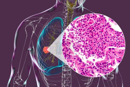 Foto de Un cuerpo humano con piel transparente que muestra cáncer de pulmón, ilustración 3D complementada por un micrograma ligero del tumor maligno de pulmón. - Imagen libre de derechos