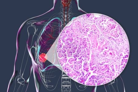 Téléchargez les photos : Un corps humain avec une peau transparente mettant en valeur le cancer du poumon, illustration 3D complétée par une micrographie lumineuse du carcinome épidermoïde pulmonaire. - en image libre de droit