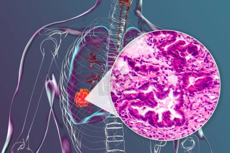 Téléchargez les photos : Un corps humain avec une peau transparente présentant un cancer du poumon, illustration 3D complétée par une micrographie lumineuse de l'adénocarcinome pulmonaire. - en image libre de droit