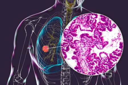 Téléchargez les photos : Un corps humain avec une peau transparente présentant un cancer du poumon, illustration 3D complétée par une micrographie lumineuse de l'adénocarcinome pulmonaire. - en image libre de droit