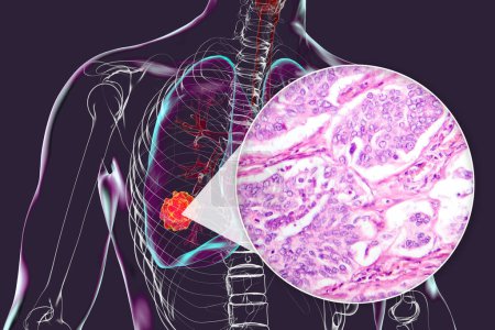 A human body with transparent skin showcasing lung cancer, 3D illustration complemented by a light micrograph of the lung adenocarcinoma.